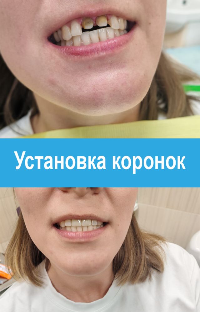 Цирконієві коронки на зуби